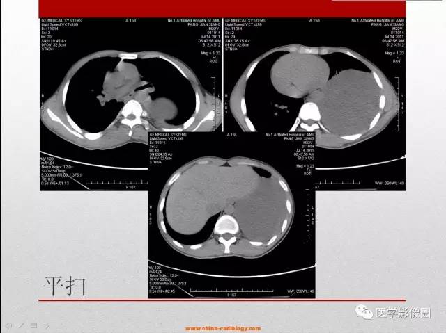 【病例】左胸腔节细胞神经纤维瘤1例CT影像表现