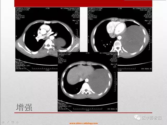 【病例】左胸腔节细胞神经纤维瘤1例CT影像表现 【病例】左胸腔节细胞神经纤维瘤1例CT影像表现