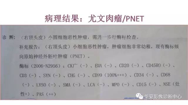 【病例】右顶部尤文氏肉瘤1例