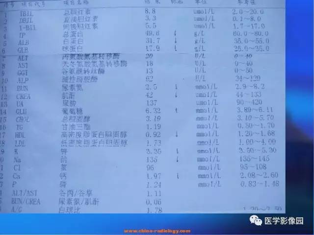 【病例】肺部良性转移性平滑肌瘤1例CT影像表现