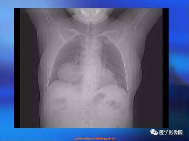 【病例】肺部良性转移性平滑肌瘤1例CT影像表现