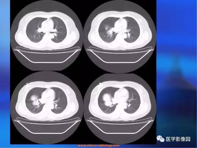 【病例】肺部良性转移性平滑肌瘤1例CT影像表现