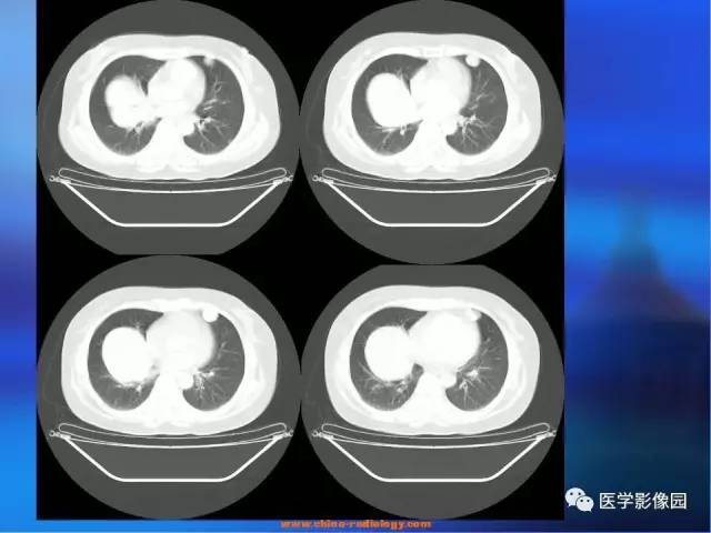 【病例】肺部良性转移性平滑肌瘤1例CT影像表现