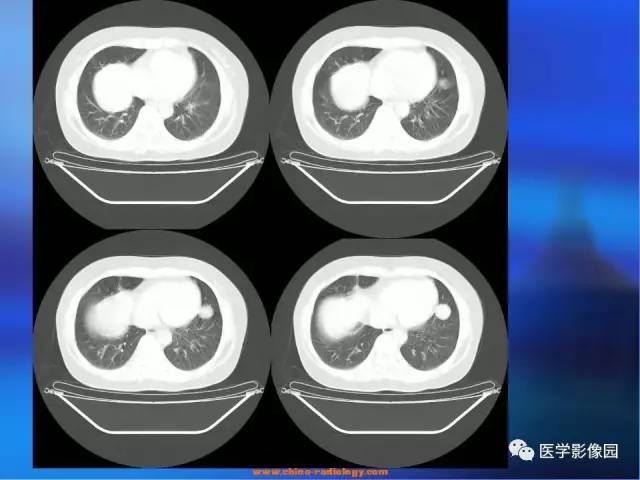 【病例】肺部良性转移性平滑肌瘤1例CT影像表现