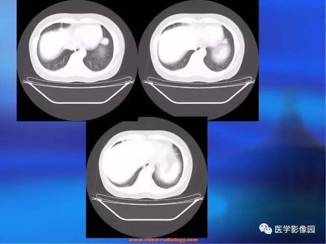 【病例】肺部良性转移性平滑肌瘤1例CT影像表现