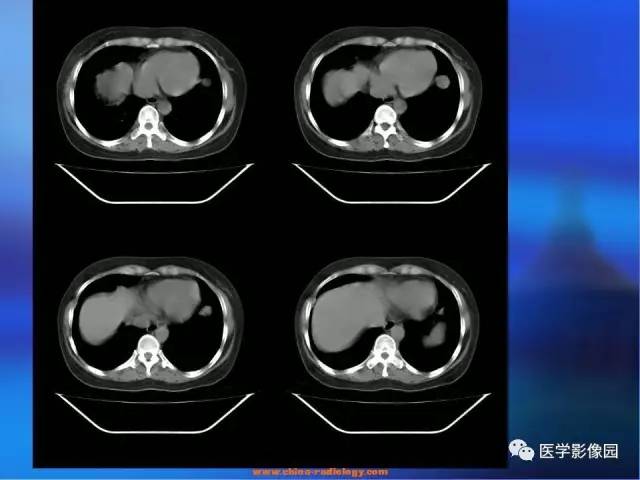 【病例】肺部良性转移性平滑肌瘤1例CT影像表现