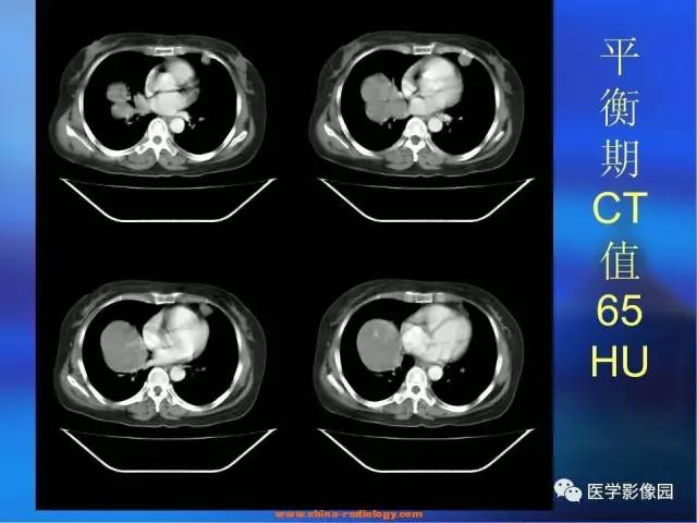 【病例】肺部良性转移性平滑肌瘤1例CT影像表现