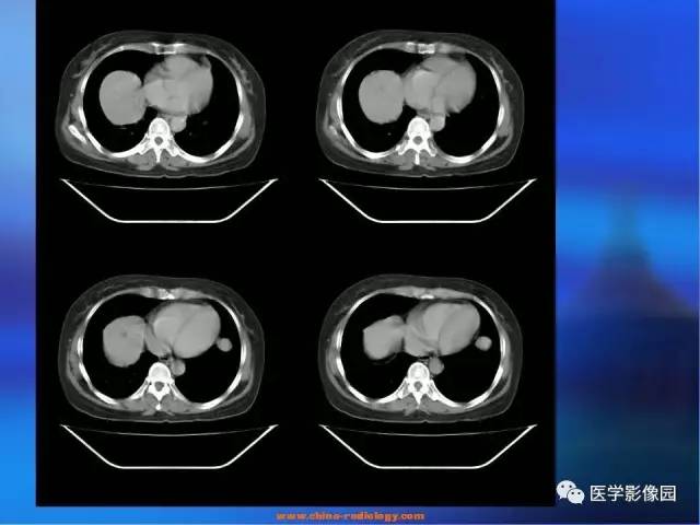 【病例】肺部良性转移性平滑肌瘤1例CT影像表现