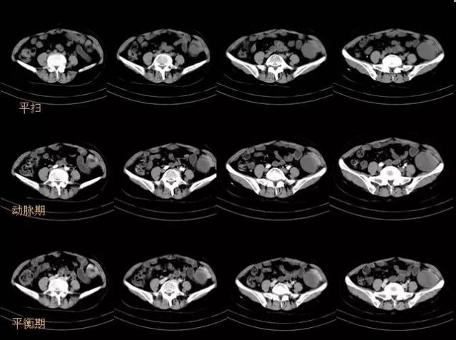 【病例】左髂窝去分化脂肪肉瘤1例CT 【病例】左髂窝去分化脂肪肉瘤1例CT
