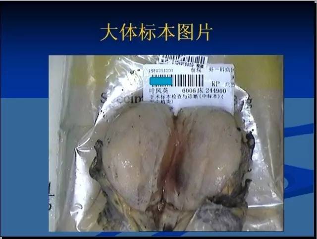 【病例】左髂窝去分化脂肪肉瘤1例CT 【病例】左髂窝去分化脂肪肉瘤1例CT