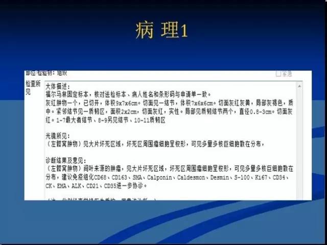 【病例】左髂窝去分化脂肪肉瘤1例CT 【病例】左髂窝去分化脂肪肉瘤1例CT