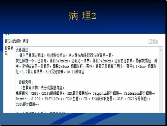 【病例】左髂窝去分化脂肪肉瘤1例CT 【病例】左髂窝去分化脂肪肉瘤1例CT