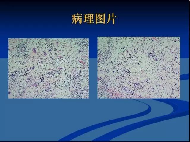 【病例】左髂窝去分化脂肪肉瘤1例CT 【病例】左髂窝去分化脂肪肉瘤1例CT