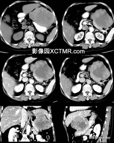 【病例】胃恶性间质瘤1例CT影像表现