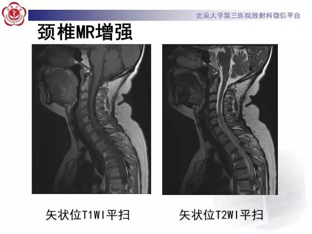【病例】视神经脊髓炎1例MR影像表现分析