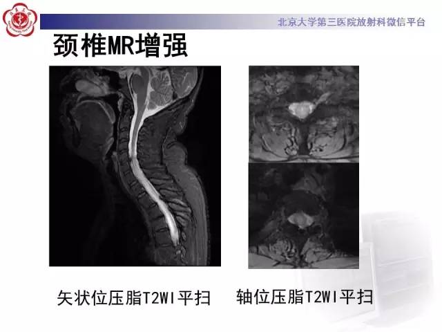 【病例】视神经脊髓炎1例MR影像表现分析