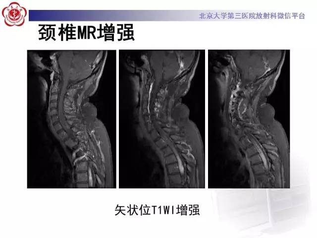 【病例】视神经脊髓炎1例MR影像表现分析