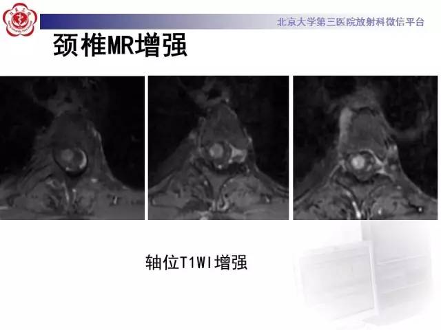 【病例】视神经脊髓炎1例MR影像表现分析