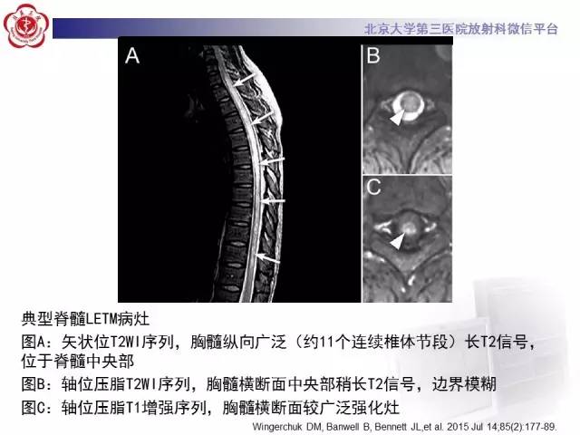 【病例】视神经脊髓炎1例MR影像表现分析