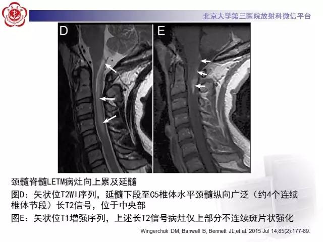 【病例】视神经脊髓炎1例MR影像表现分析