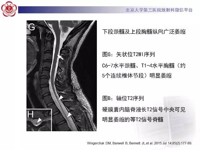【病例】视神经脊髓炎1例MR影像表现分析
