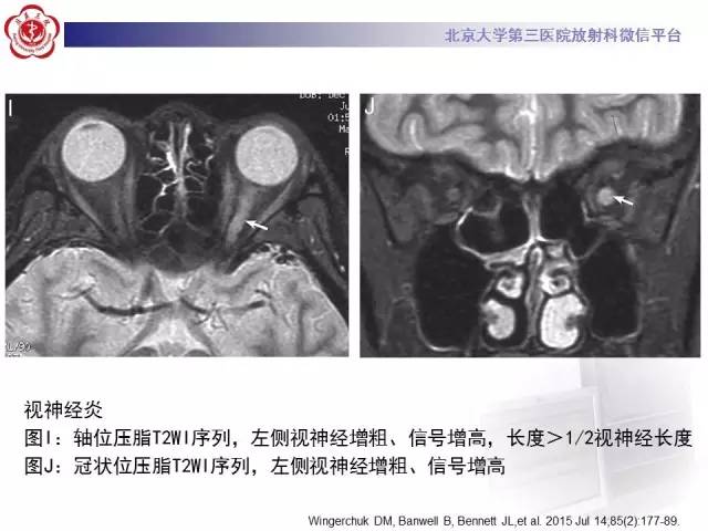 【病例】视神经脊髓炎1例MR影像表现分析