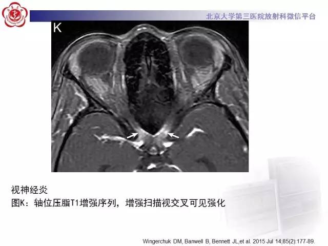 【病例】视神经脊髓炎1例MR影像表现分析