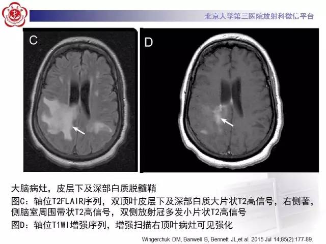 【病例】视神经脊髓炎1例MR影像表现分析