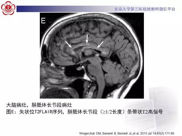 【病例】视神经脊髓炎1例MR影像表现分析