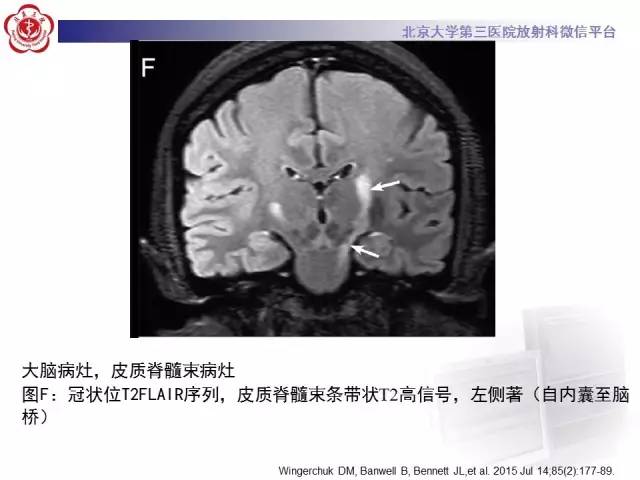【病例】视神经脊髓炎1例MR影像表现分析