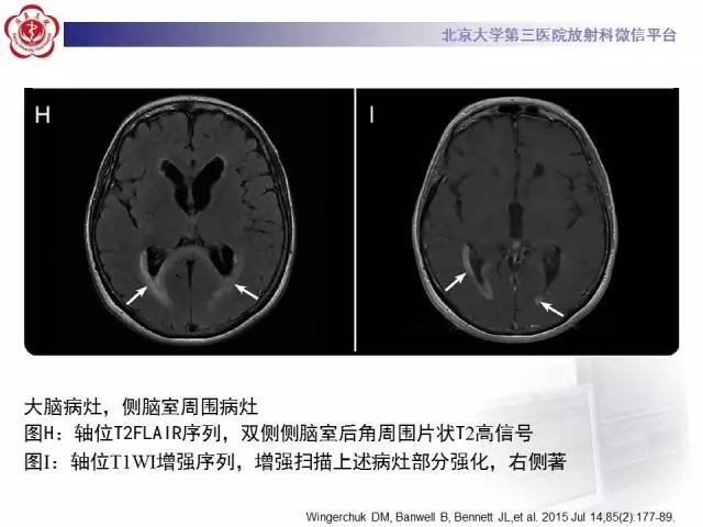 【病例】视神经脊髓炎1例MR影像表现分析
