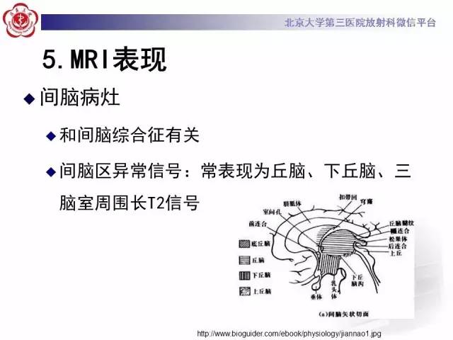 【病例】视神经脊髓炎1例MR影像表现分析