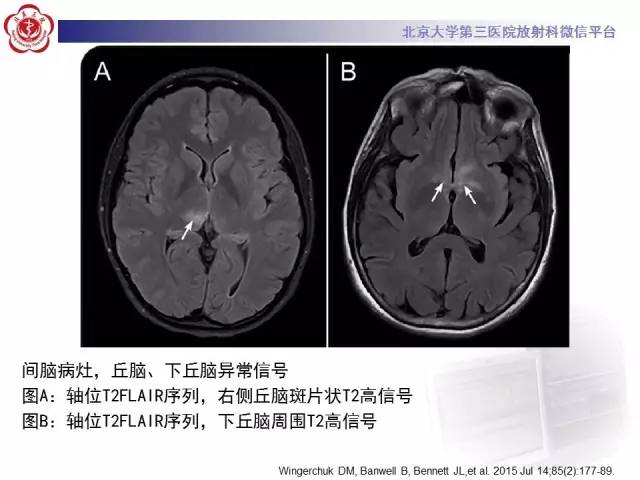 【病例】视神经脊髓炎1例MR影像表现分析