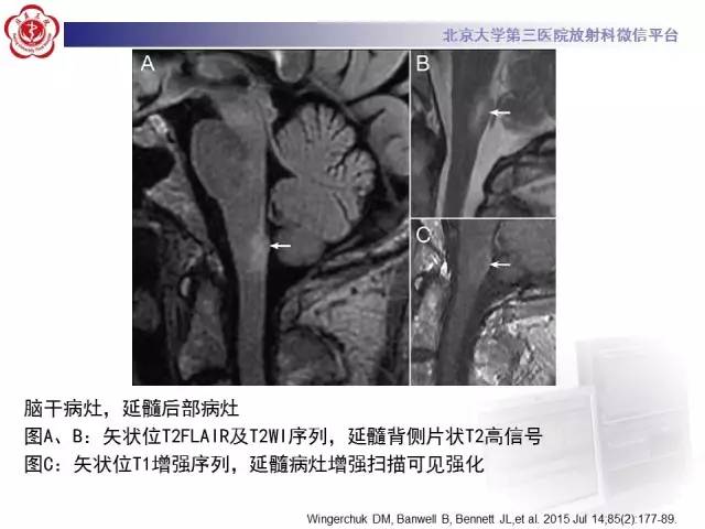 【病例】视神经脊髓炎1例MR影像表现分析