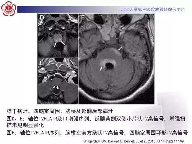 【病例】视神经脊髓炎1例MR影像表现分析