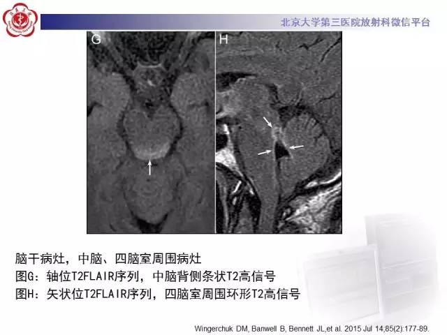【病例】视神经脊髓炎1例MR影像表现分析