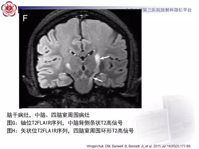 【病例】视神经脊髓炎1例MR影像表现分析