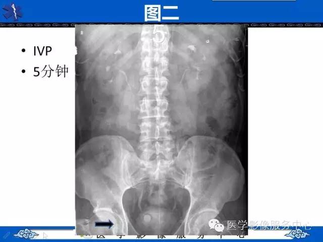 【影像征象】眼镜蛇头征