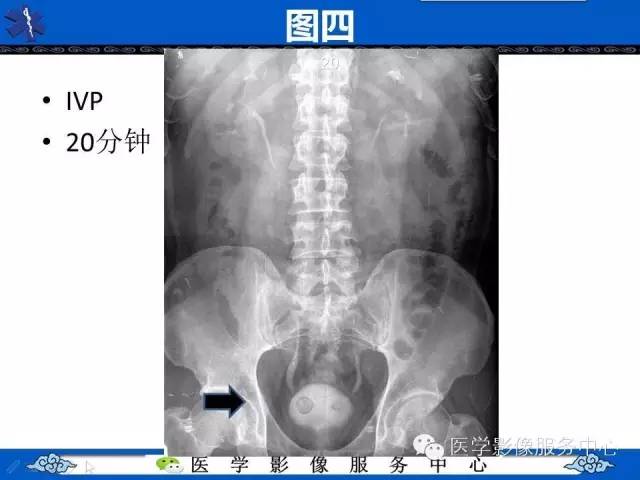 【影像征象】眼镜蛇头征