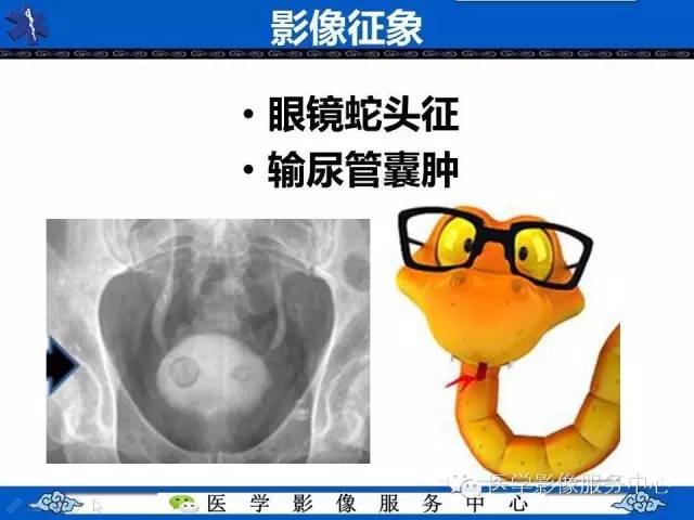 【影像征象】眼镜蛇头征
