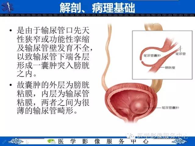 【影像征象】眼镜蛇头征