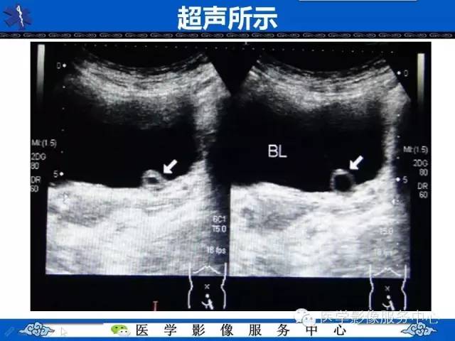 【影像征象】眼镜蛇头征