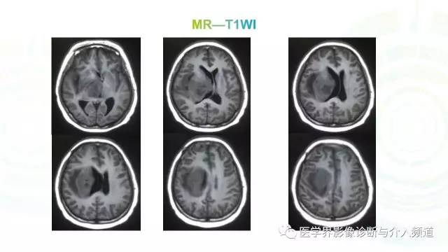 【病例】白血病粒细胞肉瘤1例MR影像表现