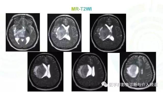 【病例】白血病粒细胞肉瘤1例MR影像表现