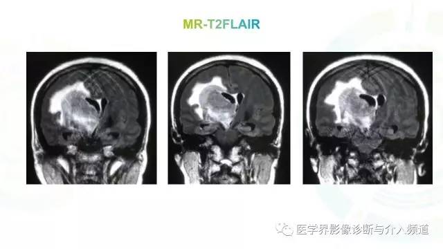 【病例】白血病粒细胞肉瘤1例MR影像表现