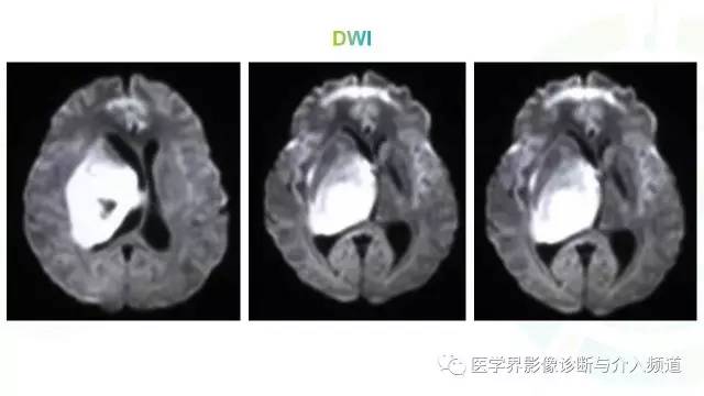 【病例】白血病粒细胞肉瘤1例MR影像表现