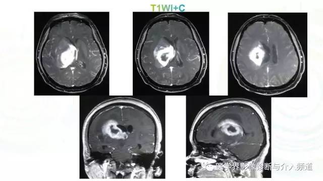 【病例】白血病粒细胞肉瘤1例MR影像表现