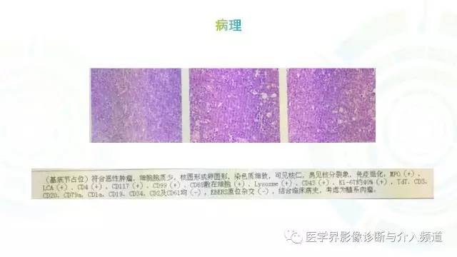 【病例】白血病粒细胞肉瘤1例MR影像表现