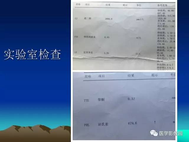 【病例】McCune-Albright 综合征1例CT及MR