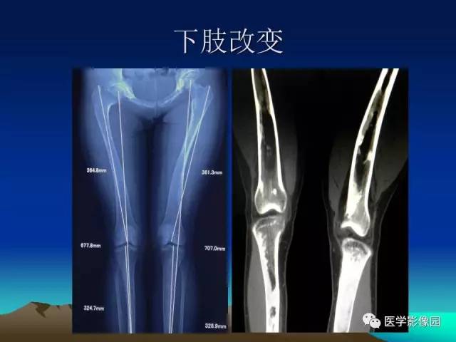 【病例】McCune-Albright 综合征1例CT及MR